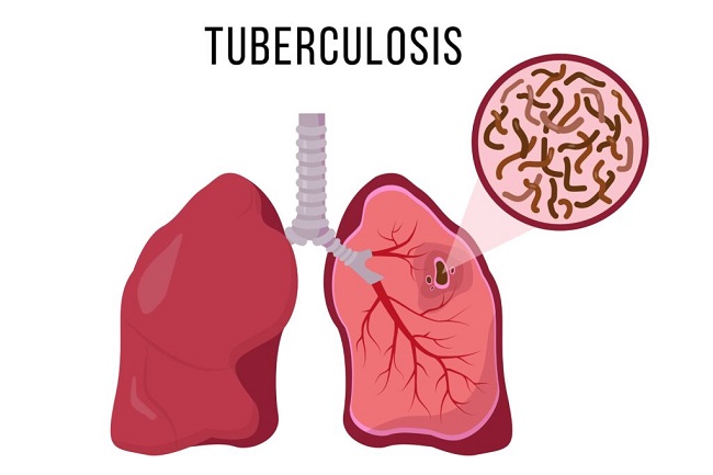 WHO perkenalkan metode baru diagnosis Tuberkulosis   